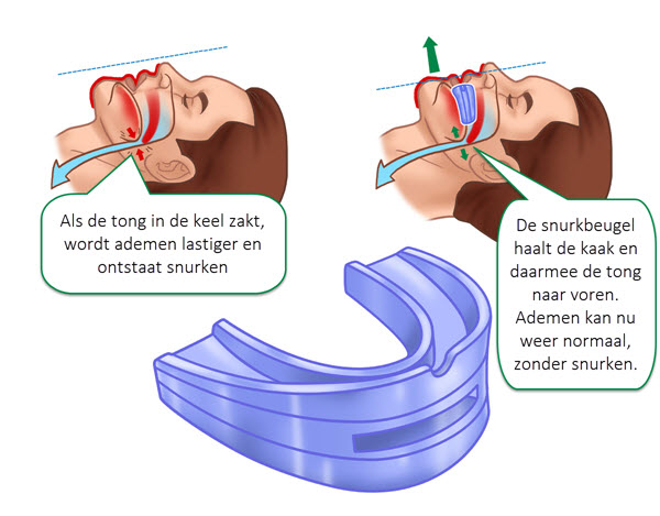 Hoe Werkt De Snurkbeugel Ook Wel MRA beugel Genoemd Hoe Werkt De Snurkbeugel Ook Wel MRA beugel Genoemd